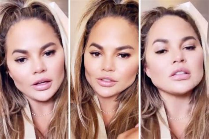 Chrissy Teigen had buccal fat removal on her face: was that all she did?