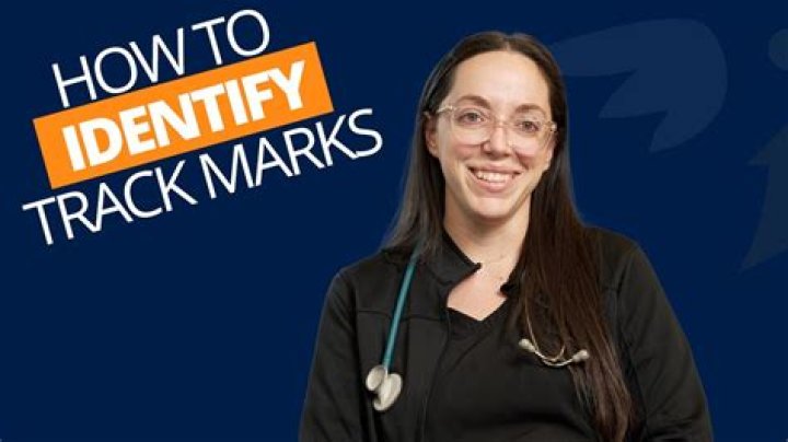 Does James Franco have track marks on his arm? (update)