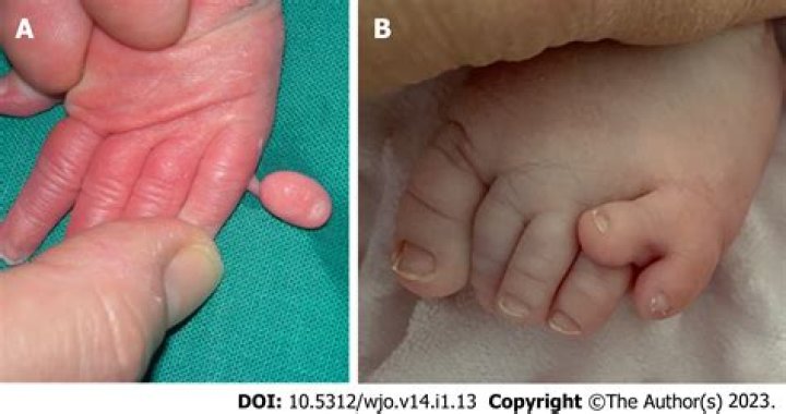 Hailey Baldwin: My two ‘crooked’ pinkies are from ectrodactyly, a genetic condition